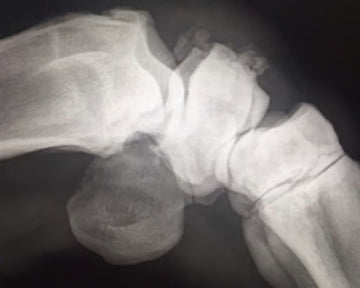 Fractured Knee is No Problem for PJS All-In-One Leg Solution