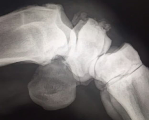 Fractured Knee is No Problem for PJS All-In-One Leg Solution